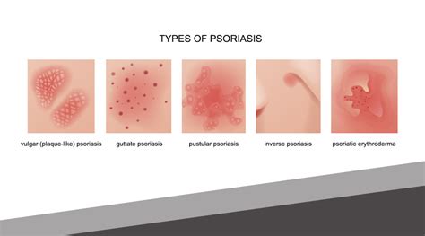 August Is National Psoriasis Awareness Month Emil A Tanghetti Md