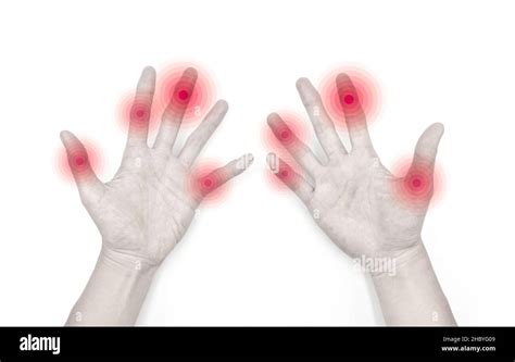 Finger Joints Inflammation Concept And Idea Of Rheumatic Arthritis