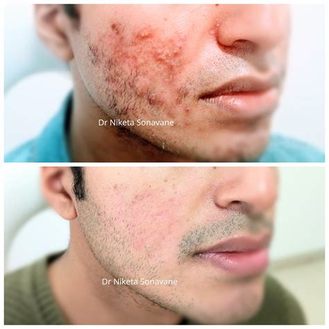 Acne Treatment In Mumbai Cost Before After Laser Acne Specialist