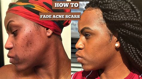 How To Fade Acne And Scars Hyperpigmentation Ft Ambi Fade Cream