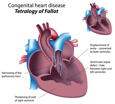 What Is Tetralogy Of Fallot The Pulse