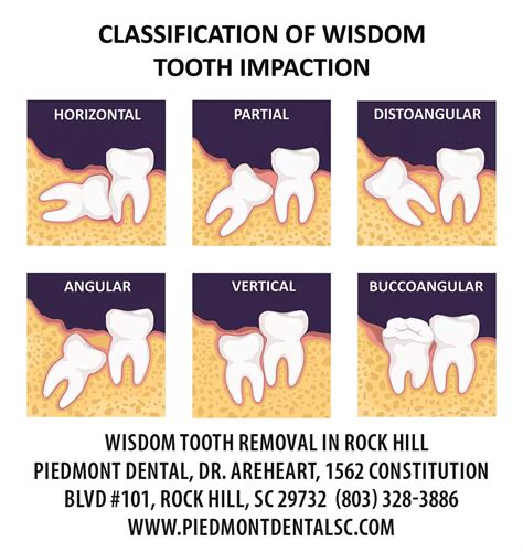 Wisdom Teeth Extraction In Rock Hill Sc Oral Surgeon For Wisdom
