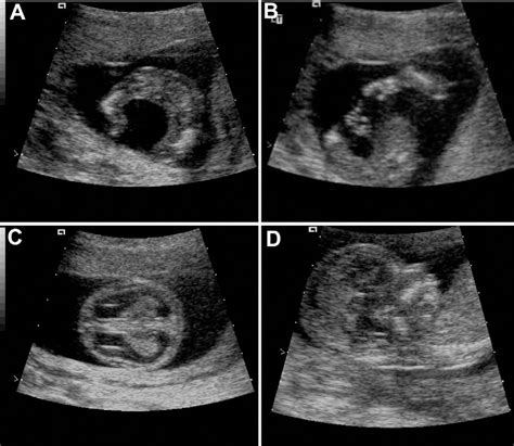 Figure 2 From Osteogenesis Imperfecta Type Ii Prenatal Diagnosis And