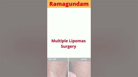 Multiple Lipomas Surgery Treatment Cost In Ramagundam Multiple