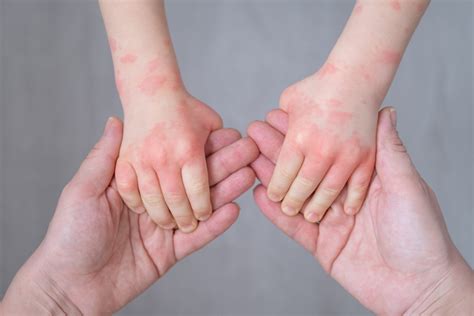 Symptoms Of Anaphylaxis What You Need To Know