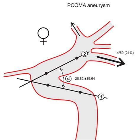 Carotid Siphon Angle α Formed By The Intersection Of Two Lines Traced