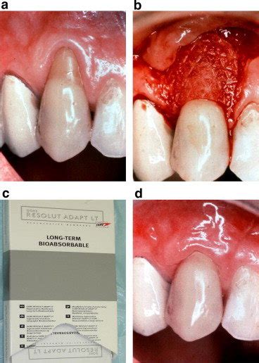 Guided Tissue Regeneration A Tooth 23 With Gingival Recession B