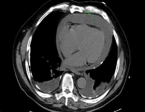 Ct Scan Showing Fluid In The Pericardial Cavity With An Effusion Of