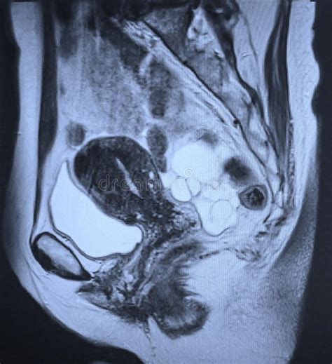 Mri Large Ovarian Cysts Radiological Exam Stock Photo Image Of