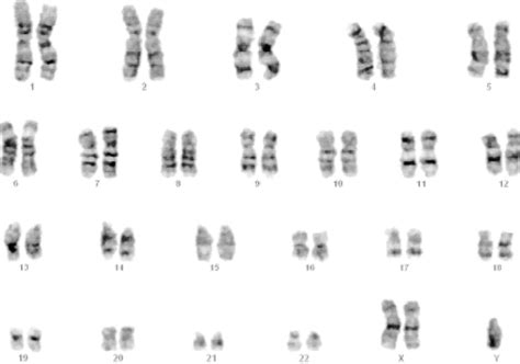 karyotype of klinefelter s syndrome patient showing 47 xxy download scientific diagram