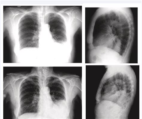 Antero Posterior And Lateral Chest X Ray Infiltrate Of Alveolar