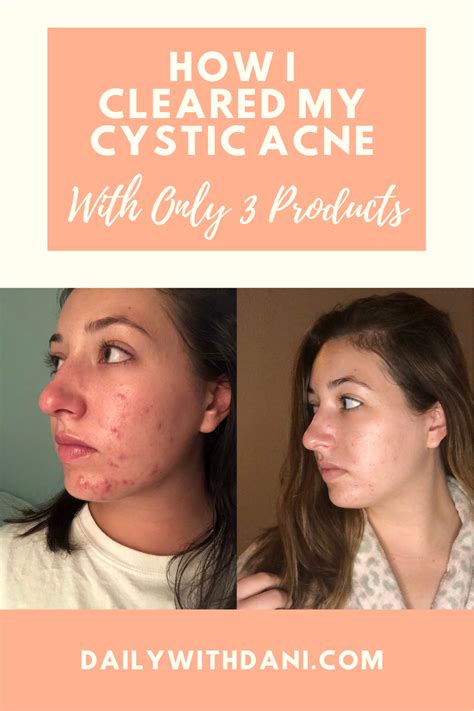 Acne Org Before And After How I Cleared My Cystic Acne Artofit