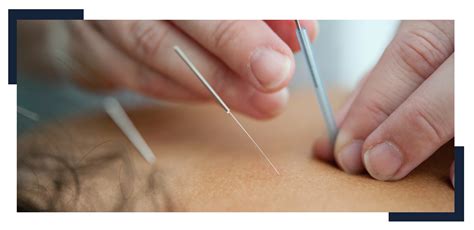 Dry Needling Physical Therapy And Its Benefits Onerehab