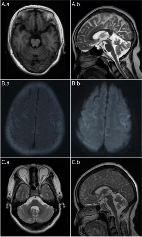 Brain Mri Findings In Patients 1 2 And 6 Download Scientific Diagram