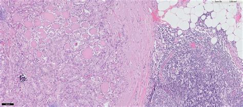 Tumor Localized In A Lymph Node From The Neck Dissection The Lymph