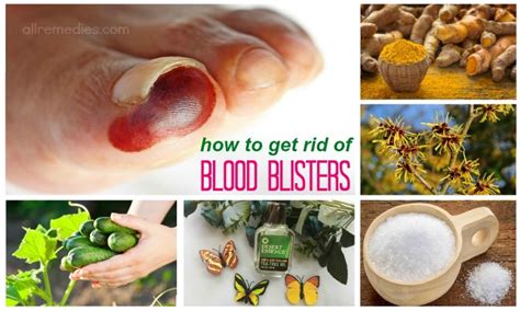 17 Tips On How To Get Rid Of Blood Blisters On Finger And Toe
