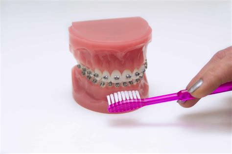 Braces Or Veneers For A Better Smile Ismile Dental Centre