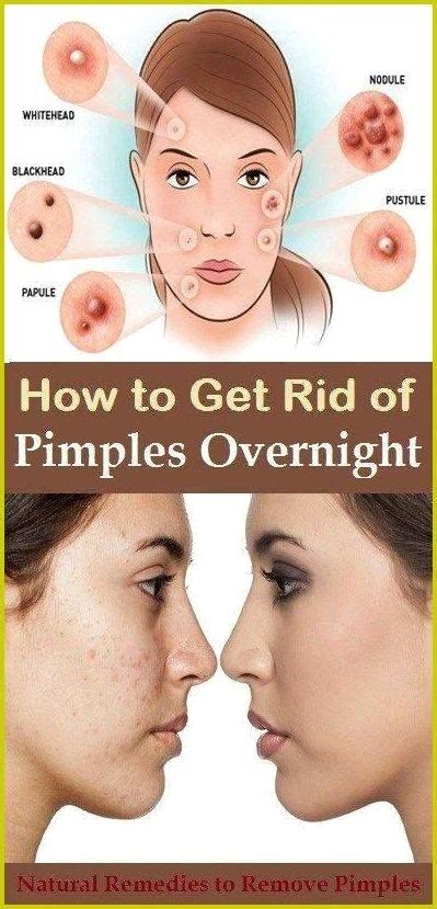 How To Remove Under The Skin Pimples Without Damaging Your Skin How
