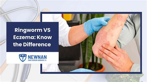 Ringworm Vs Eczema Know The Difference