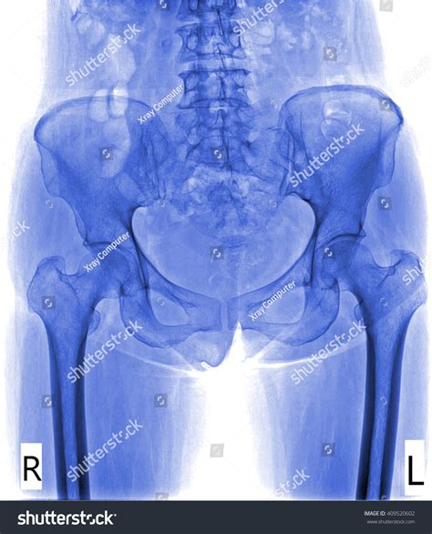 Human Female Pelvis Hip Bone Xray Picture Stock Photo 409520602