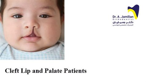 Cleft Lip And Palate Patients Dr Jamilian