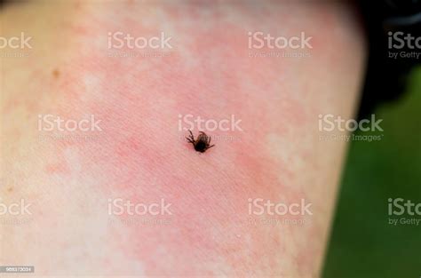 Irritation From The Bite Redness On The Skin From A Tick Bite A
