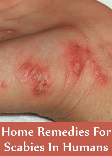 10 Home Remedies For Scabies In Humans Natural Treatments And Cure For