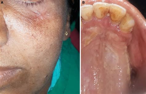 Osteomyelitis Jaw After Wisdom Teeth Extraction