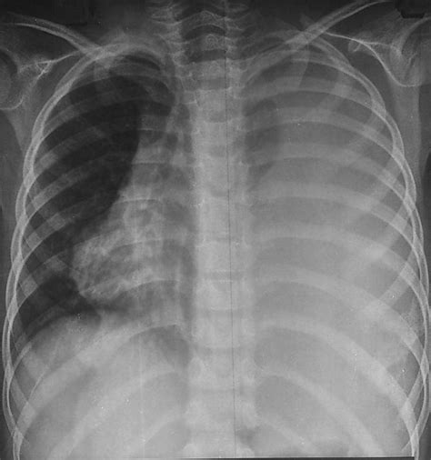 Ewing Sarcoma Of The Chest Wall Radiology Case