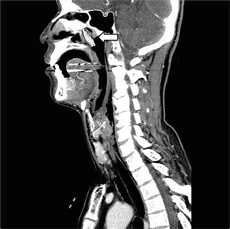 Sagittal View Of Neck Ct Scan Arrow A Neck Ct Shows The Toothbrush