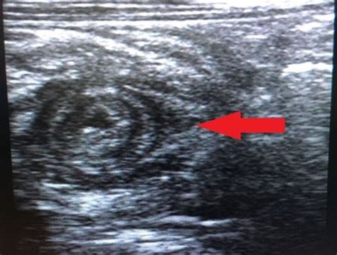 Ultrasound Of The Abdomen Showing A Typical Target Sign Red Arrow