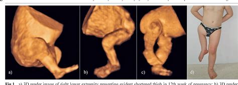 Figure From Proximal Femoral Focal Deficiency Of The Fetus Early D D Prenatal Ultrasound