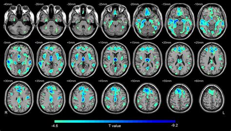 Progressive Reduction In Gray Matter In Patients With Schizophrenia Assessed With Mr Imaging By