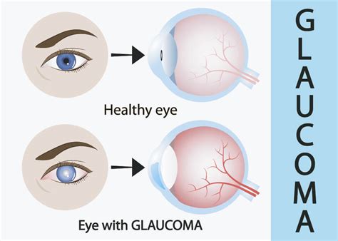 Glaucoma For Your Eyes Only