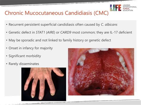Ppt Oropharyngeal Candidiasis Powerpoint Presentation Free Download