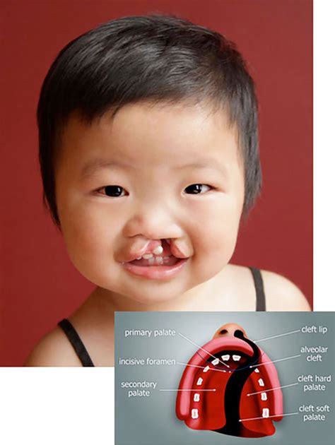 Cleft Lip And Palate Orthodontics Dental Treatment