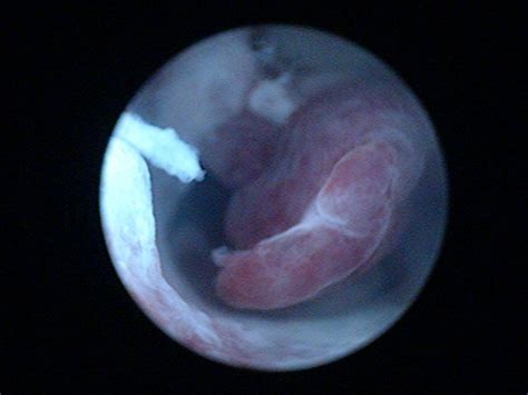 Jun 09, 2020 · having uterine polyps removed 1. Uterine Polyp Pictures