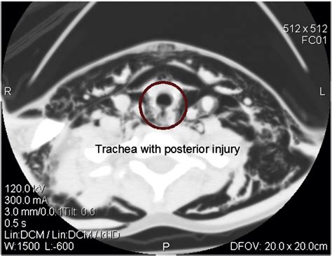 Blunt Posterior Tracheal Laceration And Esophageal Injury In A Child