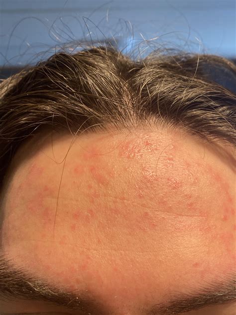 Forehead Rash Been Dealing With It For Years Only Used To Get Dry