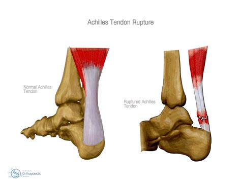 Tendons may also attach muscles to structures such as the eyeball. Achilles Rupture | Orthopaedic - James Stanley