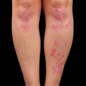 We did not find results for: Tipos de psoriasis - Guía tu cuerpo