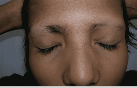Top More Than 91 Eyebrow Hair Loss Home Remedy Ineteachers
