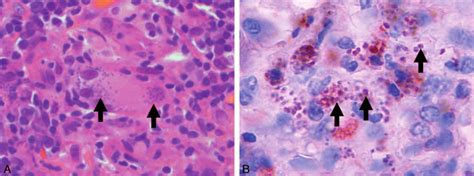 Histopathology Of The Cervical Lymphadenopathy A Hematoxylin And