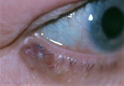 Basal Cell Carcinoma Eyelid Margin