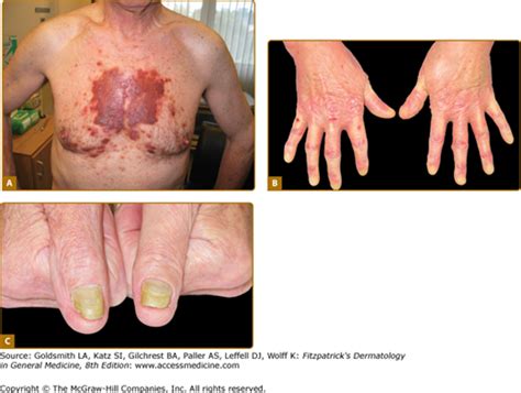 Amyloidosis Of The Skin Plastic Surgery Key