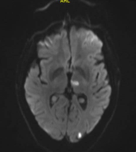 B Of Mri Brain Shows The Left Thalamic And Occipital Lobe Strokes