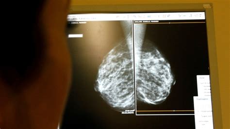Call For Universal Breast Cancer Screening In Hong Kong As Study Shows