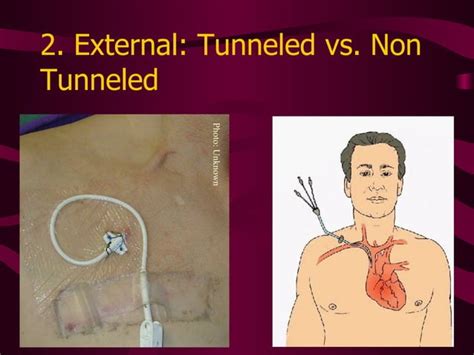 Central Venous Access Devices Made Incredibly Easy