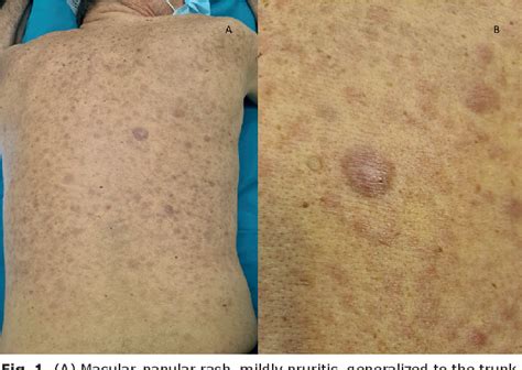 Figure 1 From Diffuse Pruritic Papular And Nodular Skin Eruption In A