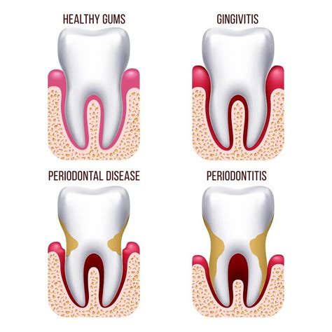 Gum Diseases Differences Between Gingivitis And Periodontitis News Dentagama